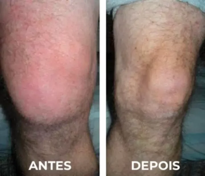 Antes e depois de um joelho inchado e um joelho saudável